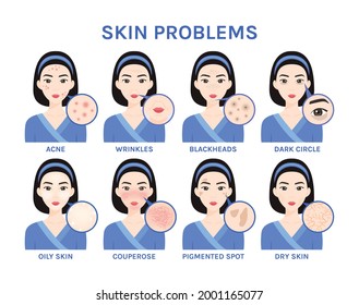 Skin Problems on the Beautiful Face of Asian Girl close-up. Acne, Rosacea, Pigmented Spots, Dark circles, Dry and Oily skin, Wrinkles. Flat color cartoon style. White background. Vector illustration.