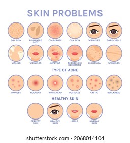 Skin Problems. Set of Icons for Different Skin Diseases of Face. Before After. Healthy Perfect Clean skin. Illustration for Medical and Cosmetic Design. White background. Flat Cartoon style. Vector. - Shutterstock ID 2068014104
