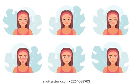 Skin problems set vector illustration. Cartoon infographic medical collection of female characters with derma troubles on face of aging and puberty, acne disease and wrinkles, allergy and melasma