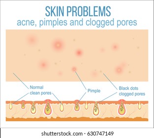 Skin problems such as acne, pimples and clogged pores. Top view of skin and side view of pores. Vector.