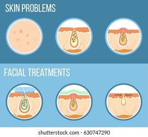 Skin problems such as acne, pimples and clogged pores. Facial treatment infographic, skin problems solution and skin care. Vector.