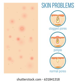 Skin problems such as acne, pimples and clogged pores. Top view of skin and side view of pores. Vector.