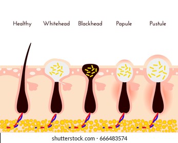 Skin problems. Types of acne pimples. Facial treatments and problem vector illustration. Whiteheads and Blackheads, Papules and Pustules