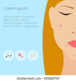 Skin problems Vector illustration The girl's face close-up with skin problems Causes of skin problems: acne, pimples, boils