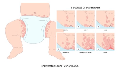 Verschiedene Arten von Babyhautinfektionen, die durch Bakterien und Pilze mit Zellulitis verursacht werden, erscheinen als Schwellung