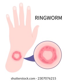 Skin rash cause jock itch fungal dermatophytosis and psoriasis ringworm eczema or body fungus tinea cruris Itchiness Scaly athlete's circular excessive infection in leg