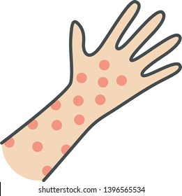 Skin Rash, Hives Color Icon. Food, Medication, Insect Bites Allergy Reaction. Urticaria, Eczema, Psoriasis. Itchy Spots, Irritation On Hand. Chickenpox, Measles Symptom. Isolated Vector Illustration