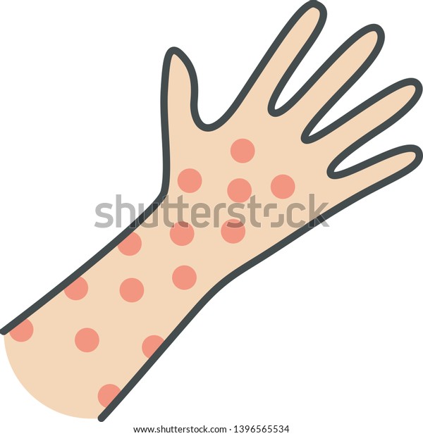 Skin Rash Hives Color Icon Food Stock Vector (Royalty Free) 1396565534 ...