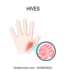 Skin Rash. Hives Or Urticaria. Hand Of The Patient And Magnification Skin With Red Itchy Bumps. Skincare