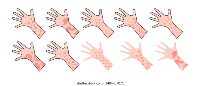 Skin rash, insect bites allergy reaction. irritation on hand. vector illustration