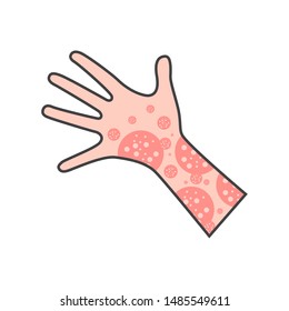 Skin Rash, Insect Bites Allergy Reaction. Irritation On Hand. Vector Illustration