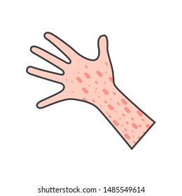 Skin rash, insect bites allergy reaction. irritation on hand. vector illustration