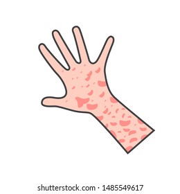 Skin Rash, Insect Bites Allergy Reaction. Irritation On Hand. Vector Illustration