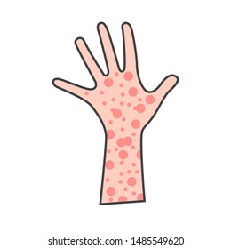 Skin Rash, Insect Bites Allergy Reaction. Irritation On Hand. Vector Illustration