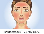 Skin redness appear on facial and neck of woman from sunburn. Illustration about danger of Ultraviolet radiation.
