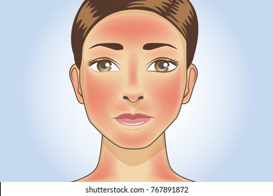 Skin redness appear on facial and neck of woman from sunburn. Illustration about danger of Ultraviolet radiation.
