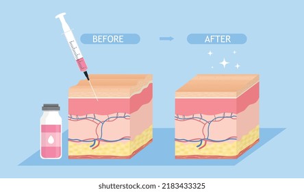 Skin rejuvenation concept. Metaphor of cosmetic procedures, beauty and hygiene. Doctors inject cosmetic products with syringe. Fight wrinkles and blackheads. Cartoon flat vector illustration