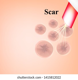 Skin scars after acne and pimples. Treatment of scars on the skin of the face with a laser. Infographics. Vector illustration on isolated background.