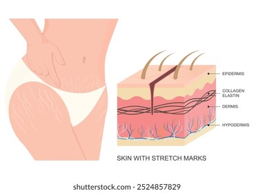 A pele com marcas de estiramento aparece quando a pele é esticada muito rapidamente para que o tecido conjuntivo subjacente acompanhe o crescimento do corpo. Saúde médica, ilustração vetorial.