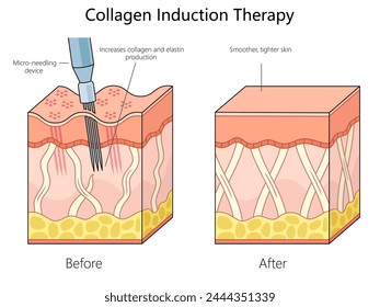 skin structure before and after collagen induction therapy using a micro-needling device for enhanced skin texture diagram schematic vector illustration. Medical science educational illustration