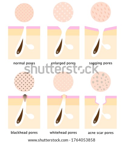 skin surface and inner structure around pores, normal, sagging, open , blackhead, whitehead, and acne scar. Beauty skin care concept