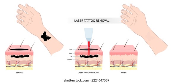 skin tattoo on hand with ink remove surgery