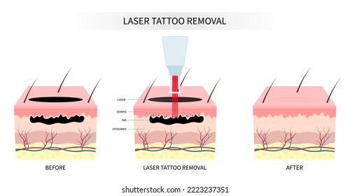 skin tattoo remove surgery treatment