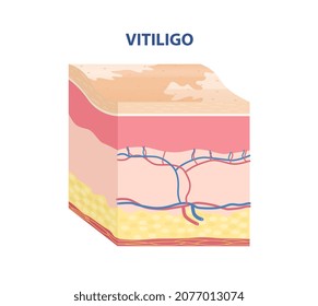 Pegatina de tipo de piel. Enfermedad del vitiligo dermatológico. Capas de piel con manchas de luz sobre dermis. Elemento de diseño para libros científicos. Ilustración vectorial isométrica de caricatura aislada en fondo blanco