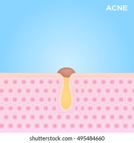skin vector . black head acne