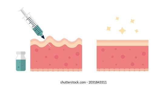 Skin with wrinkles and fine line before and after injection flat illustration. Dermatology, collagen, rejuvination concept. For topics like anti-aging therapy, biorevitalization and mesotherapy