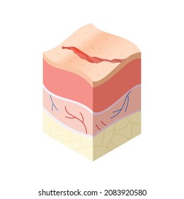 Skincare medical concept. Problems in cross-section of human skin horizontal layers structure. Anatomy illustrative model