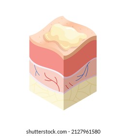 Skincare medical concept. Problems in cross-section of human skin horizontal layers structure. Anatomy illustrative model