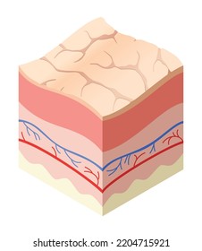 Skincare medical concept. Problems in cross-section of human skin horizontal layers structure. Anatomy illustrative model unhealthly layer of skin