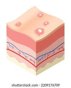 Skincare medical concept. Problems in cross-section of human skin horizontal layers structure. Anatomy illustrative model unhealthly layer of skin
