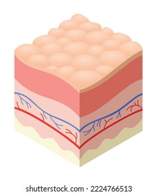 Skincare medical concept. Problems in cross-section of human skin horizontal layers structure. Anatomy illustrative model unhealthy layer of skin