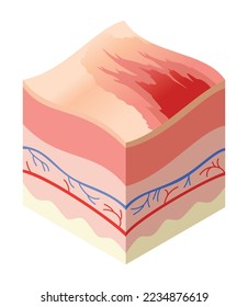 Skincare medical concept. Problems in cross-section of human skin horizontal layers structure. Anatomy illustrative model unhealthly layer of skin