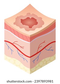 Skincare medical concept. Problems in cross-section of human skin horizontal layers structure. Anatomy illustrative model unhealthy layer of skin