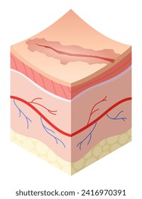 Skincare medical concept. Problems in cross-section of human skin horizontal layers structure. Anatomy illustrative model unhealthy layer of skin