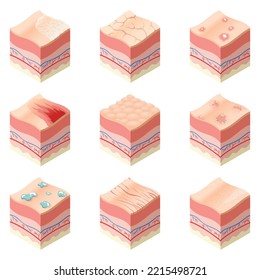 Concepto médico de atención de la piel. Conjunto de problemas de diferentes tipos de piel en la sección transversal de la estructura de capas horizontales de la piel humana. Anatomía ilustrativa capas de modelos de piel