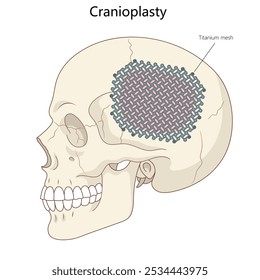 skull with a titanium mesh implant used in cranioplasty, depicting surgical repair of a cranial defect diagram hand drawn schematic vector illustration. Medical science educational illustration