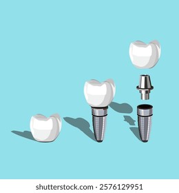 A sleek vector illustration of dental implants featuring an implant screw and prosthetic tooth, perfect for dental branding, educational materials, and oral surgery designs.