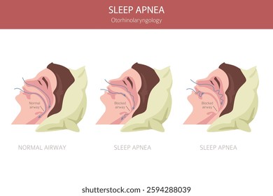 Sleep Apnea diseases. Otorhinolaryngology. Sleep related breathing disorder. Medical infographic design. Vector illustration