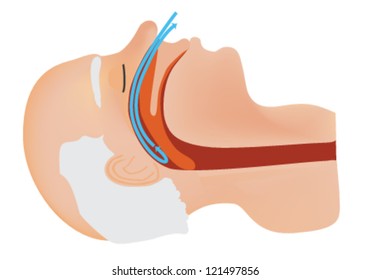 Sleep Apnea Illustration