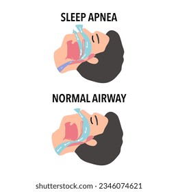 Sleep apnea is a potentially serious sleep disorder in which breathing repeatedly stops and starts. If you snore loudly and feel tired even after a full night's sleep, you might have sleep apnea.