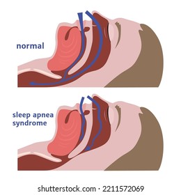 Sleep apnea. Respiratory tract diagram. Medical poster. Vector illustration