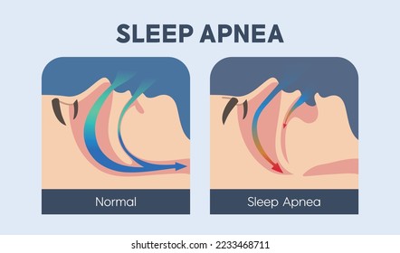 Sleep apnea is a serious sleep disorder in which breathing repeatedly stops and starts