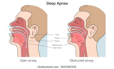 Sleep apnea structure diagram hand drawn schematic vector illustration. Medical science educational illustration