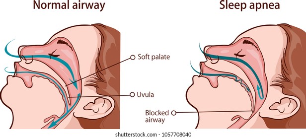 SLEEP APNEA SYNDROME