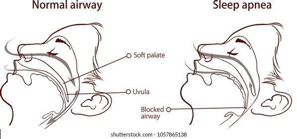 Sleep Apnea Syndrome Stock Vector (Royalty Free) 1057865138 | Shutterstock