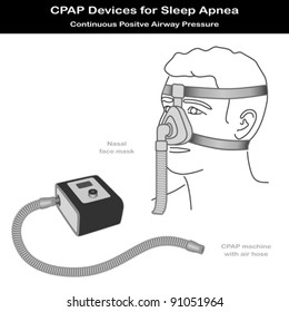 Sleep Apnea Therapy. CPAP machine with flexible air hose, nose face mask on model. Continuous positive air pressure for treatment of sleep apnea and hypopnea, EPS8 compatible.